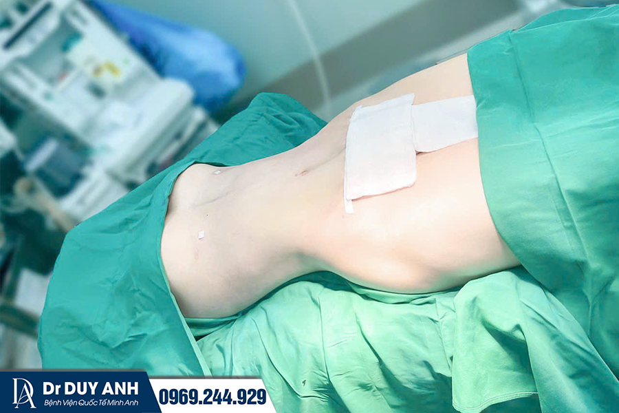 Định hình và làm mượt vùng da sau hút mỡ